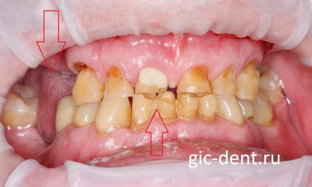 Стирание эмали и дентина, потеря зубов при бруксизме